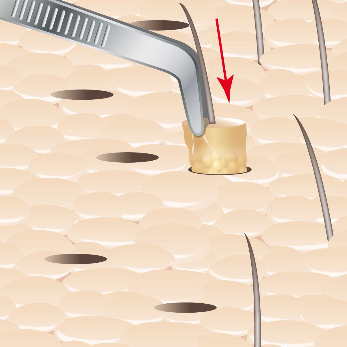 Stick-and-place follicle