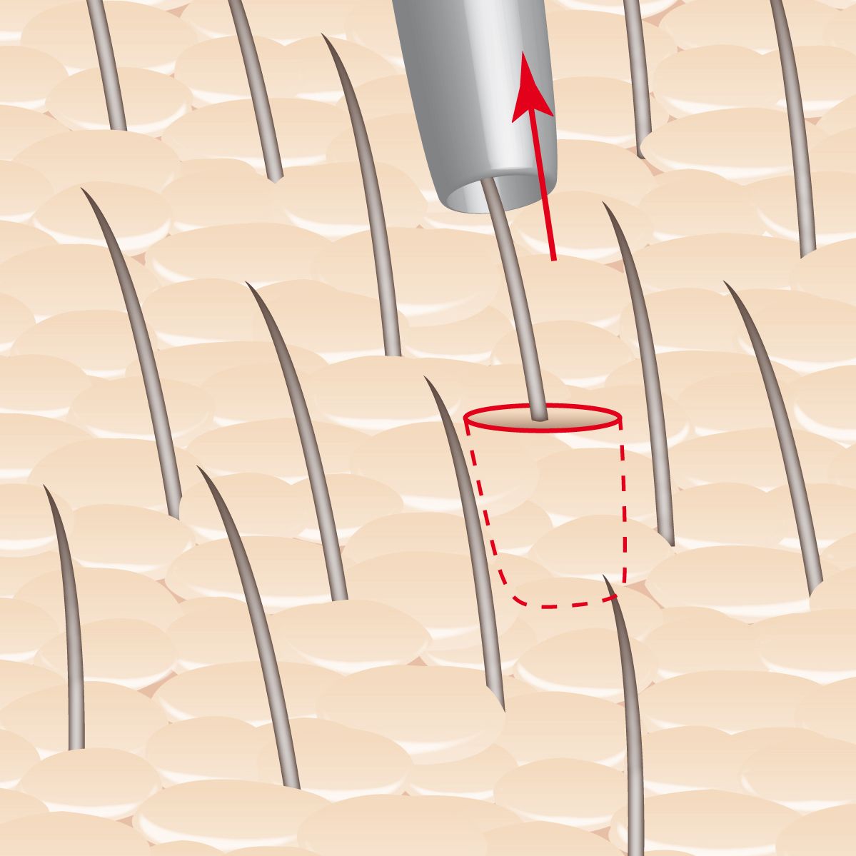 Follicle being removed by FUE