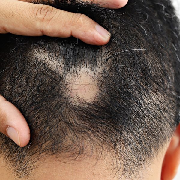 Man pointing to bald spot