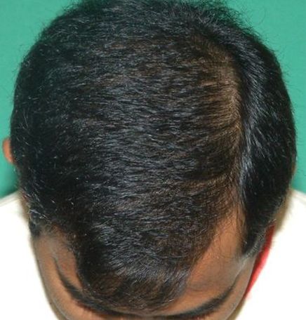 After hair restoration