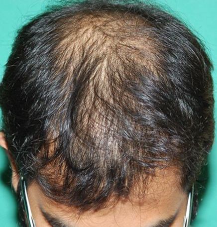 Before hair restoration