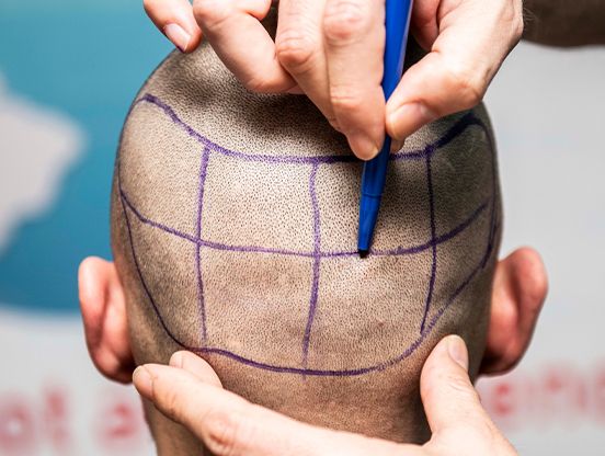 Doctor drawing grid onto back of man's shaved head