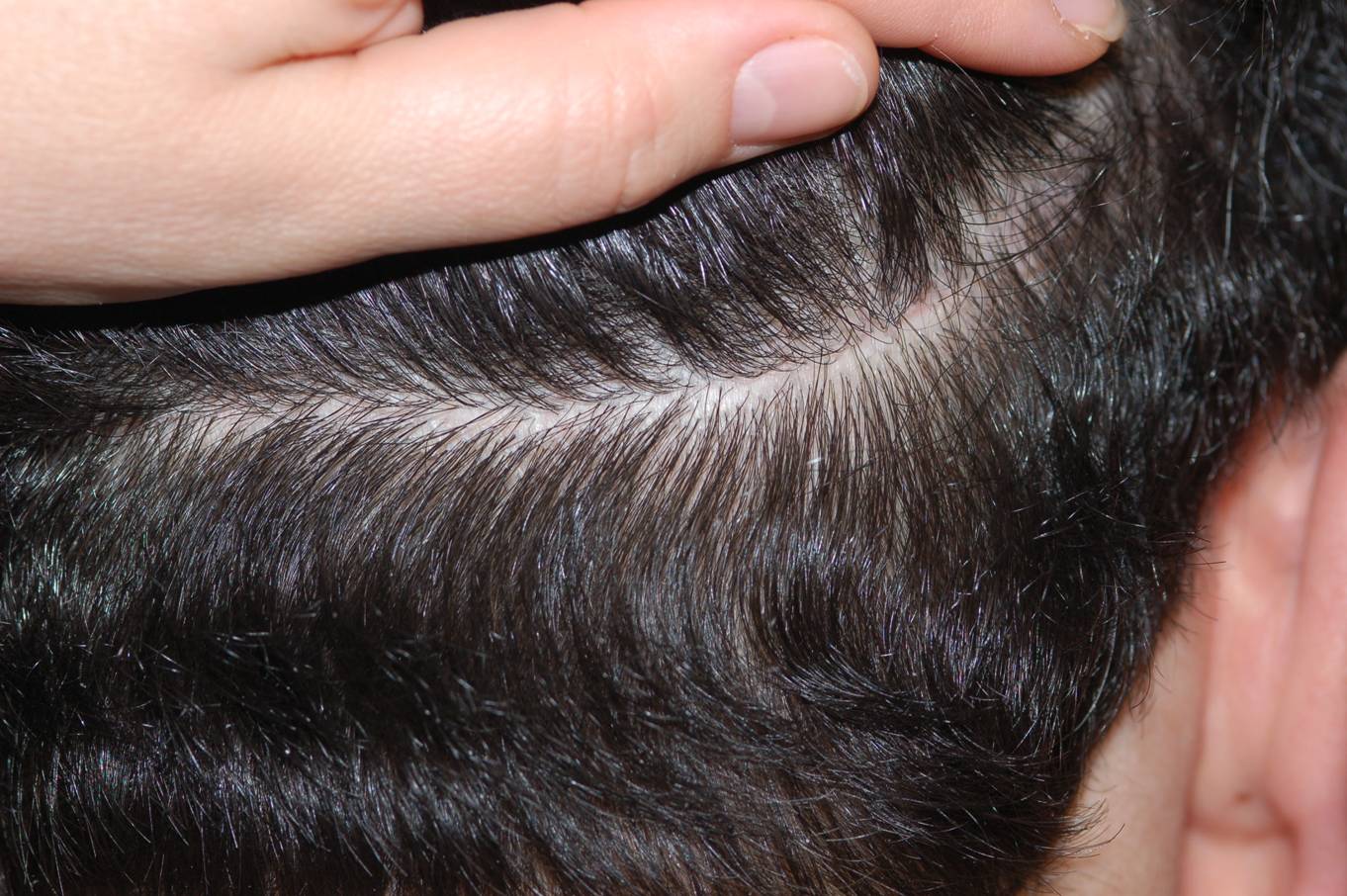 scar_1.jpg Donor area scar