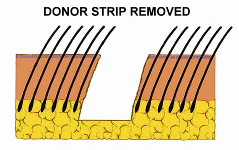 trichophytic_closure_1A.jpg Donor area graphic