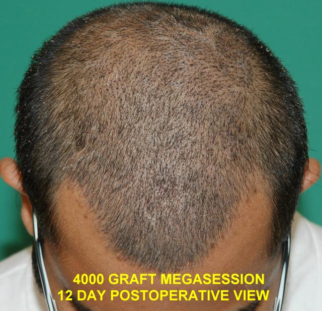 megasession_postop_2_weeks_labeled.jpg megasession_postop_2_weeks_labeled.jpg