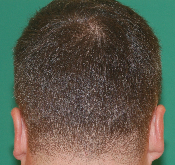 donor_scar_2.jpg donor_scar_2.jpg