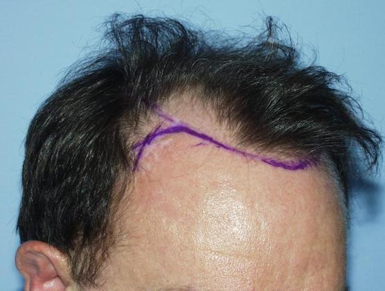 Before Frontal-Midscalp Restoration