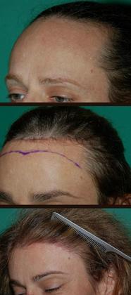 Hair loss surgery before and after side view