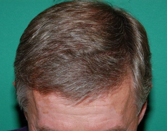 hairline restored by hair restoration