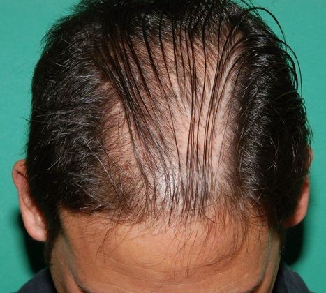 Before Hair loss treatment