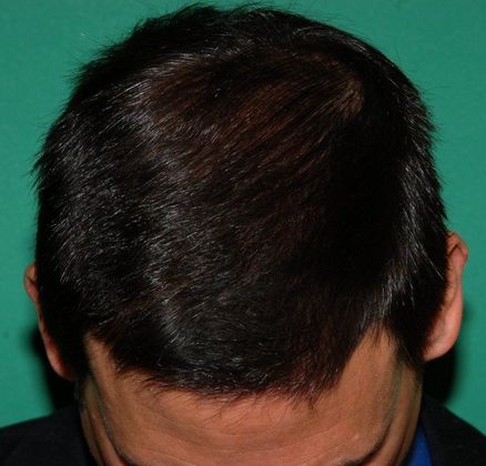 After Hair loss treatment